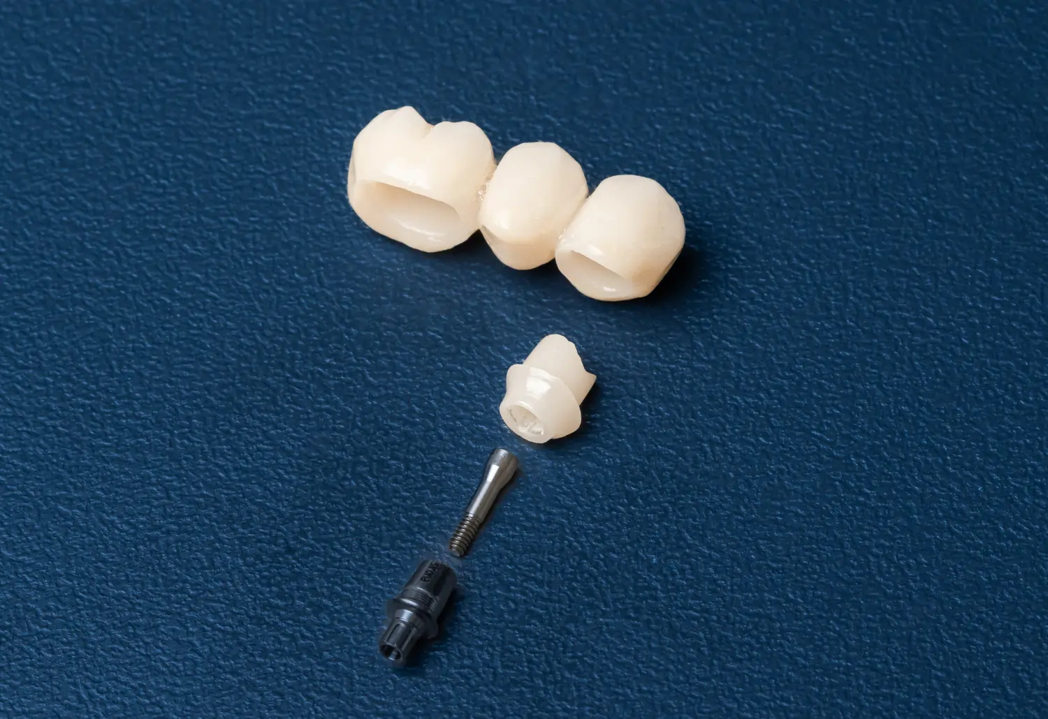 Zahnimplantat als festsitzenden Zahnersatz