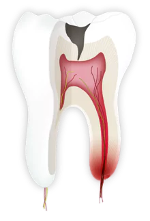 Zahnschmerzen dürch eine Entzündung