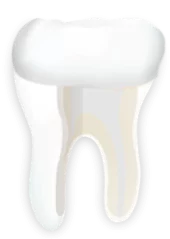 Zahnkrone nach der Wurzelkanalbehandlung